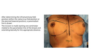 Inframamry Incision presention BREASTAUGmentaion final.pptx