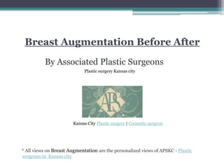 Breast AugmentationBefore After By Associated Plastic Surgeons      * All views on Breast Augmentation are the personalized views of APSKC - Plastic surgeons in  Kansas city Plastic surgery Kansas city Kansas City Plastic surgery| Cosmetic surgeon 