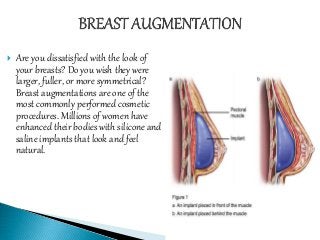  Are you dissatisfied with the look of
your breasts? Do you wish they were
larger, fuller, or more symmetrical?
Breast augmentations are one of the
most commonly performed cosmetic
procedures. Millions of women have
enhanced their bodies with silicone and
saline implants that look and feel
natural.
 