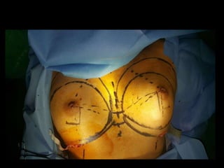 Pre-Operative marking
 