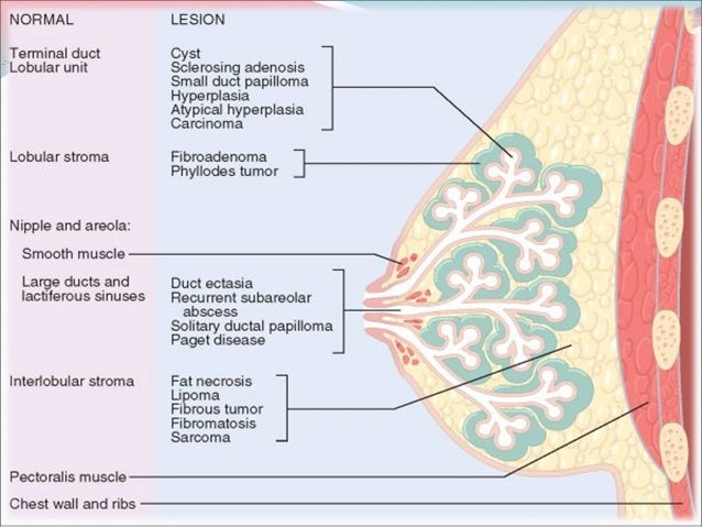 Breastbenigndisorderspathology 110914231905-phpapp01