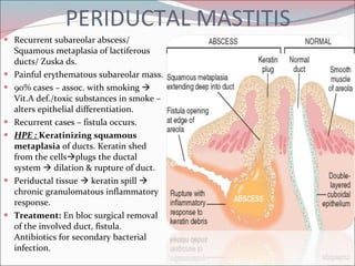 PERIDUCTAL MASTITIS Recurrent subareolar abscess/ Squamous metaplasia of lactiferous ducts/ Zuska ds. Painful erythematous subareolar mass. 90% cases – assoc. with smoking    Vit.A def./toxic substances in smoke – alters epithelial differentiation. Recurrent cases – fistula occurs. HPE :  Keratinizing squamous metaplasia  of ducts. Keratin shed from the cells  plugs the ductal system    dilation & rupture of duct. Periductal tissue    keratin spill    chronic granulomatous inflammatory response. Treatment:  En bloc surgical removal of the involved duct, fistula. Antibiotics for secondary bacterial infection. 