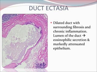 DUCT ECTASIA Dilated duct with surrounding fibrosis and chronic inflammation. Lumen of the duct    eosinophilic secretion & markedly attenuated epithelium. 