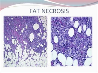 FAT NECROSIS 
