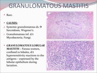 GRANULOMATOUS MASTITIS Rare. CAUSES: Systemic granulomatous ds.   Sarcoidosis, Wegener’s. Granulomatous inf. d/t Mycobacteria, Fungi. GRANULOMATOUS LOBULAR MASTITIS   – Parous women, confined to lobules, d/t hypersensitivity reactions to the antigens – expressed by the lobular epithelium during lactation. 