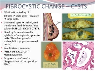 FIBROCYSTIC CHANGE – CYSTS Dilation & unfolding of  lobules    small cysts – coalesce    large cysts. Unopened cysts    turbid ,semi translucent fluid    brown/blue colour    BLUE – DOME CYSTS. Lined by flattened atrophic epithelium/metaplastic  apocrine cells ( Abundant granular eosinophilic cytoplasm + round nuclei). Calcification – common. “ MILK OF CALCIUM”  – Mammographers Diagnosis – confirmed – disappearance of the cyst after FNAC. 