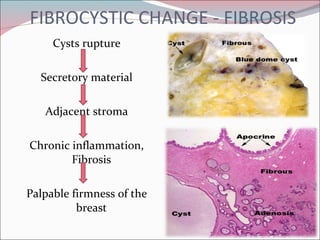 FIBROCYSTIC CHANGE - FIBROSIS Cysts rupture Secretory material Adjacent stroma Chronic inflammation, Fibrosis Palpable firmness of the breast 
