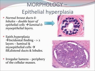 MORPHOLOGY –  Epithelial hyperplasia Normal breast ducts & lobules – double layer of epithelial cells    luminal & myoepithelial layers. Epith.hyperplasia   Incidental finding - > 2 layers – luminal & myoepithelial cells    fill,distend ducts & lobules. Irregular lumens – periphery of the cellular masses. 