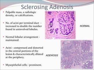 Sclerosing Adenosis Palpable mass, a radiologic density, or calcifications. No. of acini per terminal duct  -  increased to double the number found in uninvolved lobules.  Normal lobular arrangement - maintained. Acini - compressed and distorted in the central portions of the lesion & characteristically dilated at the periphery.  Myoepithelial cells - prominent.  NORMAL ADENOSIS 