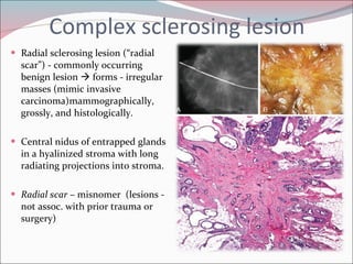 Complex sclerosing lesion Radial sclerosing lesion (“radial scar”) - commonly occurring benign lesion    forms - irregular masses (mimic invasive carcinoma)mammographically, grossly, and histologically. Central nidus of entrapped glands in a hyalinized stroma with long radiating projections into stroma. Radial scar  – misnomer  (lesions - not assoc. with prior trauma or surgery) 