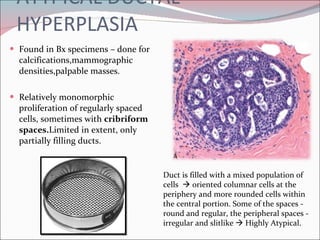 ATYPICAL DUCTAL HYPERPLASIA Found in Bx specimens – done for calcifications,mammographic densities,palpable masses. Relatively monomorphic proliferation of regularly spaced cells, sometimes with  cribriform spaces. Limited in extent, only partially filling ducts.  Duct is filled with a mixed population of cells    oriented columnar cells at the periphery and more rounded cells within the central portion. Some of the spaces - round and regular, the peripheral spaces - irregular and slitlike    Highly Atypical. 