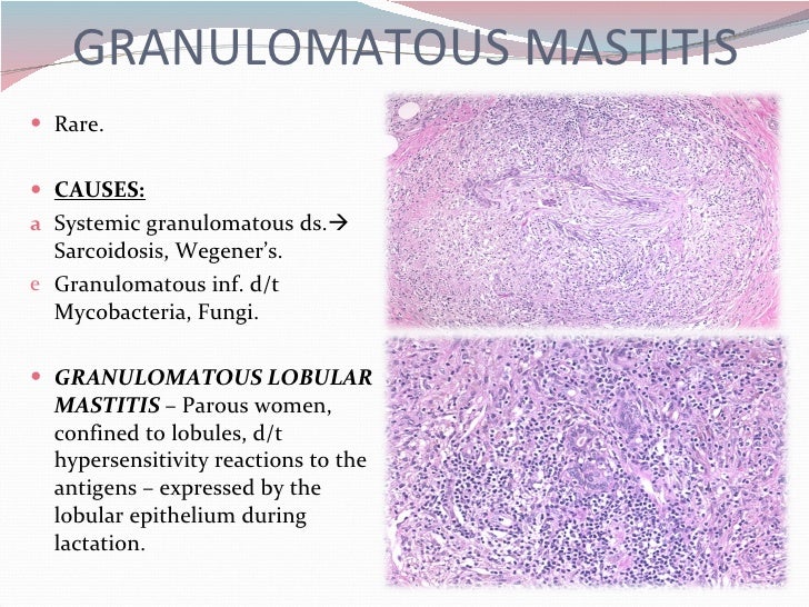 chronic mastitis of right breast tabular list