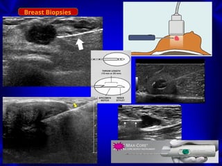Breast Biopsies for pathologic findings. | PPSX