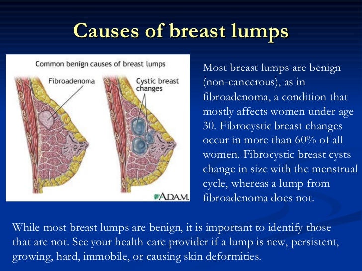 Benign breast lump what is it new porn