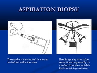 ASPIRATION BIOPSYASPIRATION BIOPSY
The needle is then moved in a to and
fro fashion within the mass
Needle tip may have to be
repositioned repeatedly on
an effort to locate a suitable
fluid-containing cavitation
 