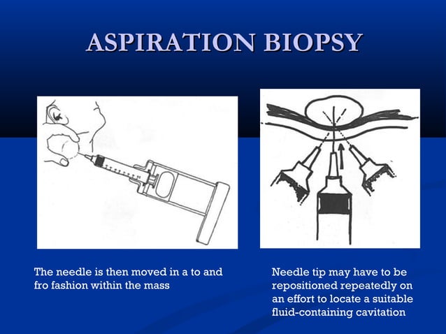 Breast biopsy ppt | PPT | Cancer | Diseases and Conditions