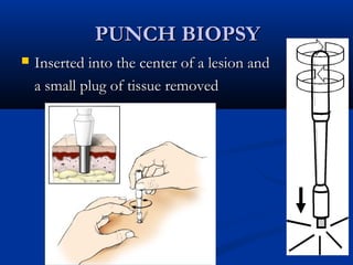 PUNCH BIOPSYPUNCH BIOPSY
 Inserted into the center of a lesion andInserted into the center of a lesion and
a small plug of tissue removeda small plug of tissue removed
 