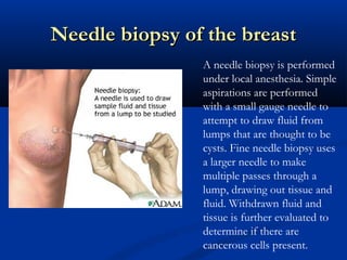Needle biopsy of the breastNeedle biopsy of the breast
A needle biopsy is performed
under local anesthesia. Simple
aspirations are performed
with a small gauge needle to
attempt to draw fluid from
lumps that are thought to be
cysts. Fine needle biopsy uses
a larger needle to make
multiple passes through a
lump, drawing out tissue and
fluid. Withdrawn fluid and
tissue is further evaluated to
determine if there are
cancerous cells present.
 