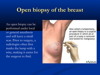 Open biopsy of the breastOpen biopsy of the breast
An open biopsy can be
performed under local
or general anesthesia
and will leave a small
scar. Prior to surgery, a
radiologist often first
marks the lump with a
wire, making it easier for
the surgeon to find.
 