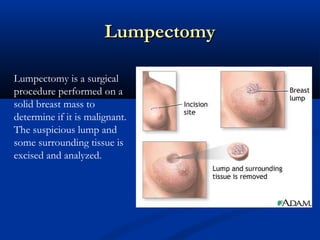 LumpectomyLumpectomy
Lumpectomy is a surgical
procedure performed on a
solid breast mass to
determine if it is malignant.
The suspicious lump and
some surrounding tissue is
excised and analyzed.
 