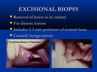 EXCISIONAL BIOPSYEXCISIONAL BIOPSY
 Removal of lesion in its entiretyRemoval of lesion in its entirety
 For discrete lesionsFor discrete lesions
 Includes 2-3 mm perimeter of normal tissueIncludes 2-3 mm perimeter of normal tissue
 Certainly benign lesionsCertainly benign lesions
 