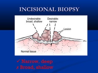 INCISIONAL BIOPSYINCISIONAL BIOPSY
 Narrow, deep
 Broad, shallow
 