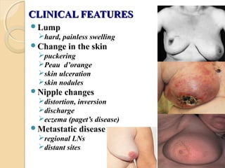 CLINICAL FEATURESCLINICAL FEATURES
Lump
hard, painless swelling
Change in the skin
puckering
Peau d’orange
skin ulceration
skin nodules
Nipple changes
distortion, inversion
discharge
eczema (paget’s disease)
Metastatic disease
regional LNs
distant sites
 