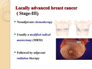 Locally advanced breast cancerLocally advanced breast cancer
(( Stage-IIIStage-III))
 Neoadjuvant chemotherapy
 Usually ...