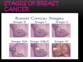 STAGES OF BREAST
CANCER
 