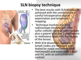 SLN biopsy technique 
•The best results with SLN biopsy are achieved with the combination of careful intraoperative digital examination and lymphatic mapping. 
• Technique involves injecting radioisotope (technetium-99m sulfur colloid) alone or radioisotope plus a patent blue dye (Lymphazurin or methylene blue) into the tissues of the breast. 
•With SLN dissection, typically 1-3 lymph nodes are removed and tested for nodal metastasis with hematoxylin and eosin (H&E) stain and IHC with an anticytokeratin cocktail.  