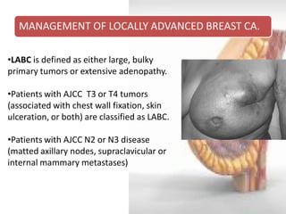 MANAGEMENT OF LOCALLY ADVANCED BREAST CA. 
•LABC is defined as either large, bulky primary tumors or extensive adenopathy. 
•Patients with AJCC T3 or T4 tumors (associated with chest wall fixation, skin ulceration, or both) are classified as LABC. 
•Patients with AJCC N2 or N3 disease (matted axillary nodes, supraclavicular or internal mammary metastases)  