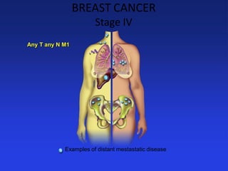 BREAST CANCER Stage IV Any T any N M1 
Examples of distant mestastatic disease  
