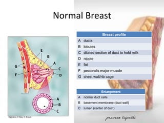 Normal Breast 
Breast profile 
A 
ducts 
B 
lobules 
C 
dilated section of duct to hold milk 
D 
nipple 
E 
fat 
F 
pectoralis major muscle 
G 
chest wall/rib cage 
32 
Enlargement 
A 
normal duct cells 
B 
basement membrane (duct wall) 
C 
lumen (center of duct) 
Illustration © Mary K. Bryson praveen tripathi 
 