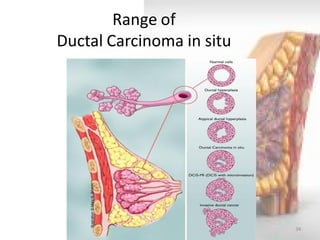 34 
Range of Ductal Carcinoma in situ 
Illustration © Mary K. Bryson  