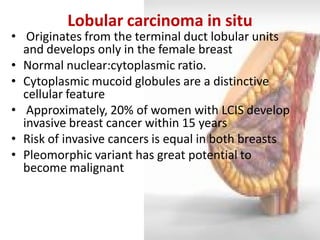 Lobular carcinoma in situ 
• Originates from the terminal duct lobular units and develops only in the female breast 
•Normal nuclear:cytoplasmic ratio. 
•Cytoplasmic mucoid globules are a distinctive cellular feature 
• Approximately, 20% of women with LCIS develop invasive breast cancer within 15 years 
•Risk of invasive cancers is equal in both breasts 
•Pleomorphic variant has great potential to become malignant 
 