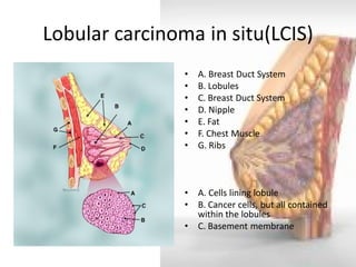Lobular carcinoma in situ(LCIS) 
•A. Breast Duct System 
•B. Lobules 
•C. Breast Duct System 
•D. Nipple 
•E. Fat 
•F. Chest Muscle 
•G. Ribs 
•A. Cells lining lobule 
•B. Cancer cells, but all contained within the lobules 
•C. Basement membrane  