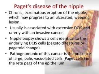 Paget's disease of the nipple 
•Chronic, eczematous eruption of the nipple, which may progress to an ulcerated, weeping lesion. 
• Usually is associated with extensive DCIS and rarerly with an invasive cancer. 
• Nipple biopsy shows a cells identical to the underlying DCIS cells (pagetoid features or pagetoid change). 
• Pathognomonic of this cancer is the presence of large, pale, vacuolated cells (Paget cells) in the rete pegs of the epithelium  