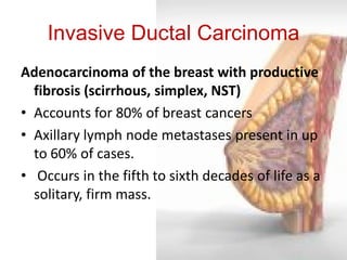 Invasive Ductal Carcinoma 
Adenocarcinoma of the breast with productive fibrosis (scirrhous, simplex, NST) 
•Accounts for 80% of breast cancers 
•Axillary lymph node metastases present in up to 60% of cases. 
• Occurs in the fifth to sixth decades of life as a solitary, firm mass.  