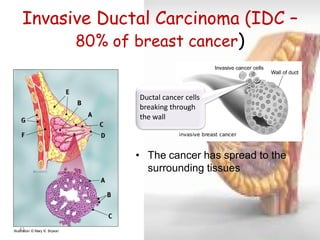 Invasive Ductal Carcinoma (IDC – 80% of breast cancer) 
43 
•The cancer has spread to the surrounding tissues 
Illustration © Mary K. Bryson 
Ductal cancer cells breaking through the wall  