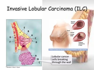 Invasive Lobular Carcinoma (ILC) 
48 
Illustration © Mary K. Bryson 
Lobular cancer cells breaking through the wall  
