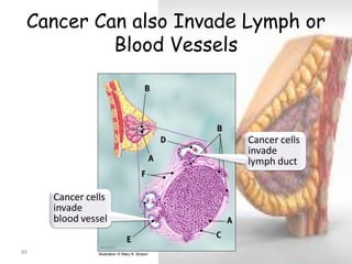 Cancer Can also Invade Lymph or Blood Vessels 
49 
Illustration © Mary K. Bryson 
Cancer cells invade lymph duct 
Cancer cells invade blood vessel  