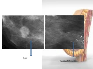 mass 
microcalcifications  