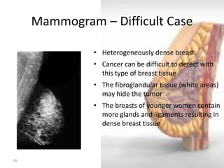 Mammogram – Difficult Case 
66 
•Heterogeneously dense breast 
•Cancer can be difficult to detect with this type of breast tissue 
•The fibroglandular tissue (white areas) may hide the tumor 
•The breasts of younger women contain more glands and ligaments resulting in dense breast tissue  