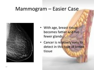 Mammogram – Easier Case 
67 
•With age, breast tissue becomes fattier and has fewer glands 
•Cancer is relatively easy to detect in this type of breast tissue  