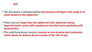 M/E
• The skin lesion is characterised by the presence of Paget’s cells singly or in
small clusters in the epidermis.
• These cells are larger than the epidermal cells, spherical, having
hyperchromatic nuclei with cytoplasmic halo that stains positively with
mucicarmine.
• The underlying breast contains invasive or non-invasive duct carcinoma
which shows no obvious direct invasion of the skin of nip.
 