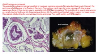 Colloid carcinoma, microscopic
This variant of breast cancer is known as colloid, or mucinous, carcinoma because of the abundant bluish mucin ( ) shown. The
carcinoma cells (◀) appear to be floating in the mucin. This mucinous matrix gives the tumor a grossly soft, blue-to-gray
appearance. Some of these tumors occur in association with BRCA1 gene mutations. This variant tends to occur in older women
as a small, circumscribed mass. It is slow growing, and when it is the predominant histologic pattern present in a breast cancer,
the prognosis is better than for nonmucinous, invasive carcinomas. They are ER positive and HER2 negative.
 