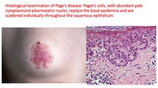 Histological examination of Page's disease: Paget's cells, with abundant pale
cytoplasmand pleomorphic nuclei, replace the basal epidermis and are
scattered individually throughout the squamous epithelium.
 
