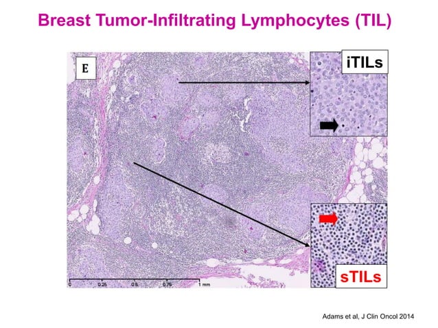 Immunotherapy For Metastatic Triple Negative Breast Cancer Pdf