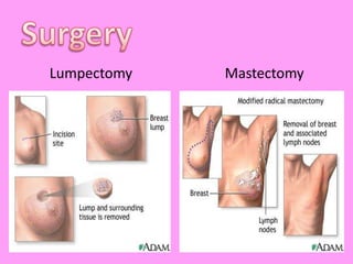 Surgery        Lumpectomy                          Mastectomy