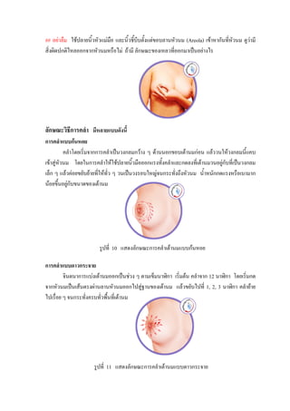 ## อยาลืม ใชปลายนิ้วหัวแมมือ และนิ้วชี้บีบตั้งแตขอบลานหัวนม (Areola) เขาหากันที่หวนม ดูวามี
                                                                                      ั      
สิ่งผิดปกติไหลออกจากหัวนมหรือไม ถามี ลักษณะของเหลวที่ออกมาเปนอยางไร




ลักษณะวิธีการคลํา มีหลายแบบดังนี้
การคลําแบบกนหอย
          คลําโดยเริ่มจากการคลําเปนวงกลมกวาง ๆ ดานนอกขอบเตานมกอน แลววนใหวงกลมนี้แคบ
เขาสูหัวนม โดยในการคลําใหใชปลายนิวมือออกแรงทังคลําและกดลงที่เตานมวนอยูกับที่เปนวงกลม
                                         ้           ้
เล็ก ๆ แลวคอยขยับยายทีใหทั่ว ๆ วนเปนวงรอบใหญจนกระทั่งถึงหัวนม น้ําหนักกดแรงหรือเบามาก
                          ่
นอยขึ้นอยูกับขนาดของเตานม
            




                        รูปที่ 10 แสดงลักษณะการคลําเตานมแบบกนหอย

การคลําแบบดาวกระจาย
         จินตนาการแบงเตานมออกเปนชวง ๆ ตามเข็มนาฬิกา เริ่มตน คลําจาก 12 นาฬิกา โดยเริ่มกด
จากหัวนมเปนเสนตรงผานลานหัวนมออกไปสูฐานของเตานม แลวขยับไปที่ 1, 2, 3 นาฬิกา คลํายาย
ไปเรื่อย ๆ จนกระทั่งครบทัวพื้นที่เตานม
                          ่




                      รูปที่ 11 แสดงลักษณะการคลําเตานมแบบดาวกระจาย
 